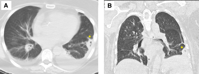 Mixed cryoglobulinaemic vasculitis with pulmonary infiltrates and ...