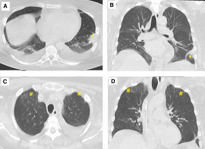 Mixed cryoglobulinaemic vasculitis with pulmonary infiltrates and ...