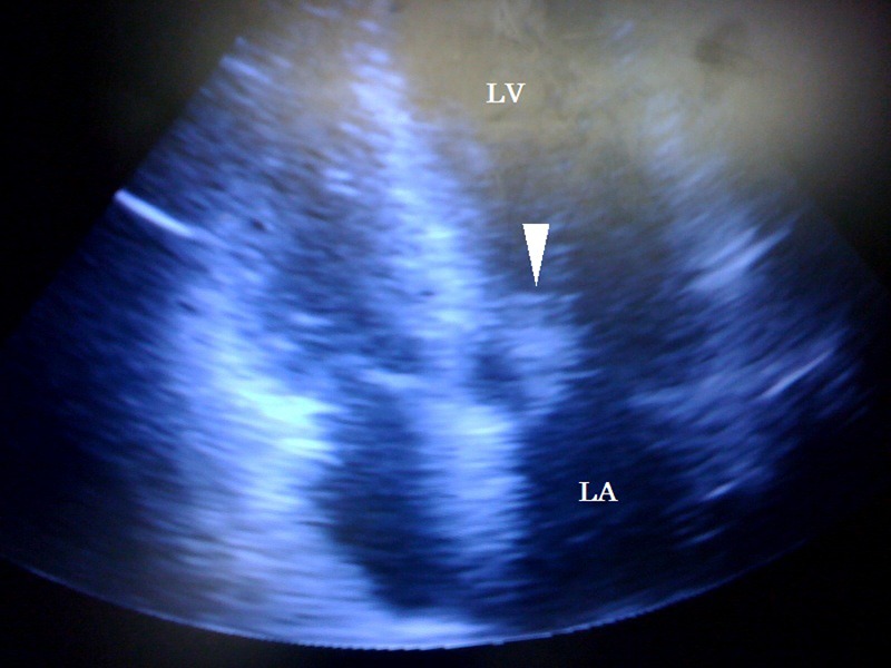 Osler's node - PMC