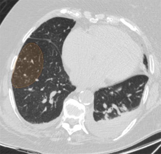 Examples of image-level annotations on axial CT images indicated with orange regions of interest. (a) Infectious opacity segmented in the left upper lobe. (b) Infectious tree-in-bud and/or micronodules segmented in the right lower lobe. (c) Infectious cavity segmented in the right upper lobe. (d) Noninfectious nodule or mass segmented in the posterior left pleura. (e) Atelectasis segmented in the left lower lobe. (f) Other noninfectious opacity segmented in the right lower lobe.