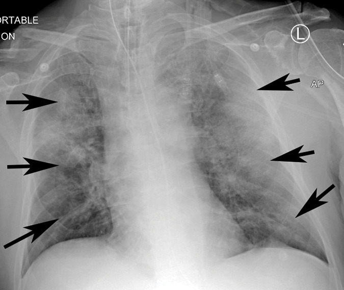 Example of CT scans and chest radiographs in the RSNA International COVID-19 Open Radiology Database. (a) Annotated axial CT image shows segmentation of characteristic bilateral multifocal ground-glass opacities in predominantly peripheral distribution (orange regions of interest). The CT image was classified as having typical appearance of coronavirus disease 2019 (COVID-19) pneumonia. (b) Annotated axial CT image shows segmentation of bilateral multifocal ground-glass opacities with diffuse distribution (orange regions of interest). The CT image was classified as having indeterminate appearance of COVID-19 pneumonia. (c) Thoracic CT image shows bilateral nodular and patchy opacities with peripheral and lower lung predominance involving four lung zones, annotated as typical for COVID-19 with moderate severity. (d) Thoracic CT image shows bilateral nodular and patchy opacities with peripheral and lower lung predominance involving more than four lung zones, annotated as typical appearance for COVID-19 and severe lung involvement. (e) Bedside chest radiograph with bilateral patchy and nodular opacities (arrows) with upper lung predominance involving more than four lung zones, annotated as indeterminate appearance for COVID-19 and severe lung involvement. (f) Bedside chest radiograph shows left lower lobe opacities (arrows) with small left pleural effusion involving a single lung zone, annotated as atypical appearance for COVID-19 and mild lung involvement. (g) Bedside chest radiograph shows bilateral patchy and nodular opacities (arrows) with upper lung predominance involving more than four lung zones, annotated as indeterminate appearance for COVID-19 and severe lung involvement. (h) Bedside chest radiograph shows left lower lobe opacity (arrow) with small left pleural effusion involving a single lung zone, annotated as atypical appearance for COVID-19 and mild lung involvement.