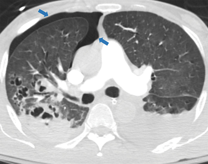 Examples of examination-level annotations on axial CT images. (a) Ground-glass opacities surrounding a nodular opacity (arrow) in the left lower lobe (halo sign). (b) Bilateral ground-glass opacities (arrows) with central clearing (reversed halo sign). (c) Reticular pattern without parenchymal opacity in the left upper lobe (arrows). (d) Perilesional vessel enlargement associated with bilateral ground-glass opacities (arrows). (e) Bronchial wall thickening most evident in the right lung (arrows). (f) Bronchiectasis in the left upper lobe (arrows). (g) Bilateral subpleural curvilinear lines (arrows). (h) Small bilateral pleural effusions (arrows). (i) Right pleural thickening (arrows). (j) Right pneumothorax (arrows). (k) Pericardial effusion (arrow). (l) Mediastinal lymphadenopathy (arrows) in the prevascular and bilateral lower paratracheal stations. (m) Pulmonary emboli (arrows) in the right lower and middle lobar pulmonary arteries.