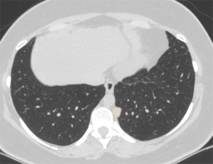 Examples of image-level annotations on axial CT images indicated with orange regions of interest. (a) Infectious opacity segmented in the left upper lobe. (b) Infectious tree-in-bud and/or micronodules segmented in the right lower lobe. (c) Infectious cavity segmented in the right upper lobe. (d) Noninfectious nodule or mass segmented in the posterior left pleura. (e) Atelectasis segmented in the left lower lobe. (f) Other noninfectious opacity segmented in the right lower lobe.