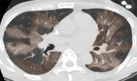 Example of CT scans and chest radiographs in the RSNA International COVID-19 Open Radiology Database. (a) Annotated axial CT image shows segmentation of characteristic bilateral multifocal ground-glass opacities in predominantly peripheral distribution (orange regions of interest). The CT image was classified as having typical appearance of coronavirus disease 2019 (COVID-19) pneumonia. (b) Annotated axial CT image shows segmentation of bilateral multifocal ground-glass opacities with diffuse distribution (orange regions of interest). The CT image was classified as having indeterminate appearance of COVID-19 pneumonia. (c) Thoracic CT image shows bilateral nodular and patchy opacities with peripheral and lower lung predominance involving four lung zones, annotated as typical for COVID-19 with moderate severity. (d) Thoracic CT image shows bilateral nodular and patchy opacities with peripheral and lower lung predominance involving more than four lung zones, annotated as typical appearance for COVID-19 and severe lung involvement. (e) Bedside chest radiograph with bilateral patchy and nodular opacities (arrows) with upper lung predominance involving more than four lung zones, annotated as indeterminate appearance for COVID-19 and severe lung involvement. (f) Bedside chest radiograph shows left lower lobe opacities (arrows) with small left pleural effusion involving a single lung zone, annotated as atypical appearance for COVID-19 and mild lung involvement. (g) Bedside chest radiograph shows bilateral patchy and nodular opacities (arrows) with upper lung predominance involving more than four lung zones, annotated as indeterminate appearance for COVID-19 and severe lung involvement. (h) Bedside chest radiograph shows left lower lobe opacity (arrow) with small left pleural effusion involving a single lung zone, annotated as atypical appearance for COVID-19 and mild lung involvement.