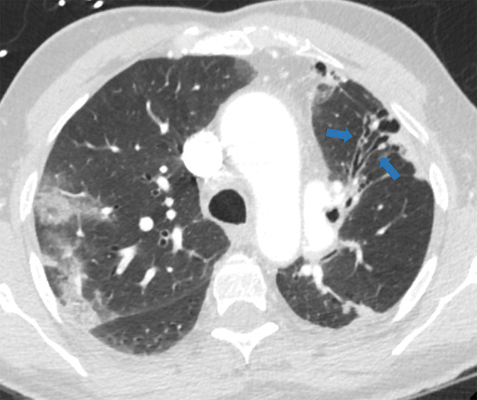 Examples of examination-level annotations on axial CT images. (a) Ground-glass opacities surrounding a nodular opacity (arrow) in the left lower lobe (halo sign). (b) Bilateral ground-glass opacities (arrows) with central clearing (reversed halo sign). (c) Reticular pattern without parenchymal opacity in the left upper lobe (arrows). (d) Perilesional vessel enlargement associated with bilateral ground-glass opacities (arrows). (e) Bronchial wall thickening most evident in the right lung (arrows). (f) Bronchiectasis in the left upper lobe (arrows). (g) Bilateral subpleural curvilinear lines (arrows). (h) Small bilateral pleural effusions (arrows). (i) Right pleural thickening (arrows). (j) Right pneumothorax (arrows). (k) Pericardial effusion (arrow). (l) Mediastinal lymphadenopathy (arrows) in the prevascular and bilateral lower paratracheal stations. (m) Pulmonary emboli (arrows) in the right lower and middle lobar pulmonary arteries.