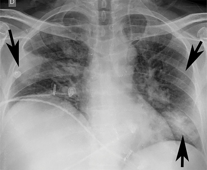 Example of CT scans and chest radiographs in the RSNA International COVID-19 Open Radiology Database. (a) Annotated axial CT image shows segmentation of characteristic bilateral multifocal ground-glass opacities in predominantly peripheral distribution (orange regions of interest). The CT image was classified as having typical appearance of coronavirus disease 2019 (COVID-19) pneumonia. (b) Annotated axial CT image shows segmentation of bilateral multifocal ground-glass opacities with diffuse distribution (orange regions of interest). The CT image was classified as having indeterminate appearance of COVID-19 pneumonia. (c) Thoracic CT image shows bilateral nodular and patchy opacities with peripheral and lower lung predominance involving four lung zones, annotated as typical for COVID-19 with moderate severity. (d) Thoracic CT image shows bilateral nodular and patchy opacities with peripheral and lower lung predominance involving more than four lung zones, annotated as typical appearance for COVID-19 and severe lung involvement. (e) Bedside chest radiograph with bilateral patchy and nodular opacities (arrows) with upper lung predominance involving more than four lung zones, annotated as indeterminate appearance for COVID-19 and severe lung involvement. (f) Bedside chest radiograph shows left lower lobe opacities (arrows) with small left pleural effusion involving a single lung zone, annotated as atypical appearance for COVID-19 and mild lung involvement. (g) Bedside chest radiograph shows bilateral patchy and nodular opacities (arrows) with upper lung predominance involving more than four lung zones, annotated as indeterminate appearance for COVID-19 and severe lung involvement. (h) Bedside chest radiograph shows left lower lobe opacity (arrow) with small left pleural effusion involving a single lung zone, annotated as atypical appearance for COVID-19 and mild lung involvement.