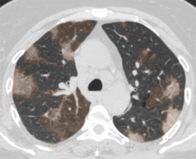 Example of CT scans and chest radiographs in the RSNA International COVID-19 Open Radiology Database. (a) Annotated axial CT image shows segmentation of characteristic bilateral multifocal ground-glass opacities in predominantly peripheral distribution (orange regions of interest). The CT image was classified as having typical appearance of coronavirus disease 2019 (COVID-19) pneumonia. (b) Annotated axial CT image shows segmentation of bilateral multifocal ground-glass opacities with diffuse distribution (orange regions of interest). The CT image was classified as having indeterminate appearance of COVID-19 pneumonia. (c) Thoracic CT image shows bilateral nodular and patchy opacities with peripheral and lower lung predominance involving four lung zones, annotated as typical for COVID-19 with moderate severity. (d) Thoracic CT image shows bilateral nodular and patchy opacities with peripheral and lower lung predominance involving more than four lung zones, annotated as typical appearance for COVID-19 and severe lung involvement. (e) Bedside chest radiograph with bilateral patchy and nodular opacities (arrows) with upper lung predominance involving more than four lung zones, annotated as indeterminate appearance for COVID-19 and severe lung involvement. (f) Bedside chest radiograph shows left lower lobe opacities (arrows) with small left pleural effusion involving a single lung zone, annotated as atypical appearance for COVID-19 and mild lung involvement. (g) Bedside chest radiograph shows bilateral patchy and nodular opacities (arrows) with upper lung predominance involving more than four lung zones, annotated as indeterminate appearance for COVID-19 and severe lung involvement. (h) Bedside chest radiograph shows left lower lobe opacity (arrow) with small left pleural effusion involving a single lung zone, annotated as atypical appearance for COVID-19 and mild lung involvement.