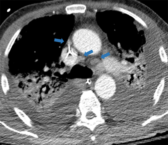 Examples of examination-level annotations on axial CT images. (a) Ground-glass opacities surrounding a nodular opacity (arrow) in the left lower lobe (halo sign). (b) Bilateral ground-glass opacities (arrows) with central clearing (reversed halo sign). (c) Reticular pattern without parenchymal opacity in the left upper lobe (arrows). (d) Perilesional vessel enlargement associated with bilateral ground-glass opacities (arrows). (e) Bronchial wall thickening most evident in the right lung (arrows). (f) Bronchiectasis in the left upper lobe (arrows). (g) Bilateral subpleural curvilinear lines (arrows). (h) Small bilateral pleural effusions (arrows). (i) Right pleural thickening (arrows). (j) Right pneumothorax (arrows). (k) Pericardial effusion (arrow). (l) Mediastinal lymphadenopathy (arrows) in the prevascular and bilateral lower paratracheal stations. (m) Pulmonary emboli (arrows) in the right lower and middle lobar pulmonary arteries.