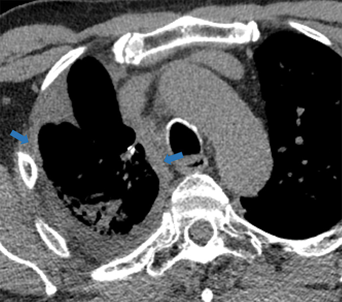 Examples of examination-level annotations on axial CT images. (a) Ground-glass opacities surrounding a nodular opacity (arrow) in the left lower lobe (halo sign). (b) Bilateral ground-glass opacities (arrows) with central clearing (reversed halo sign). (c) Reticular pattern without parenchymal opacity in the left upper lobe (arrows). (d) Perilesional vessel enlargement associated with bilateral ground-glass opacities (arrows). (e) Bronchial wall thickening most evident in the right lung (arrows). (f) Bronchiectasis in the left upper lobe (arrows). (g) Bilateral subpleural curvilinear lines (arrows). (h) Small bilateral pleural effusions (arrows). (i) Right pleural thickening (arrows). (j) Right pneumothorax (arrows). (k) Pericardial effusion (arrow). (l) Mediastinal lymphadenopathy (arrows) in the prevascular and bilateral lower paratracheal stations. (m) Pulmonary emboli (arrows) in the right lower and middle lobar pulmonary arteries.