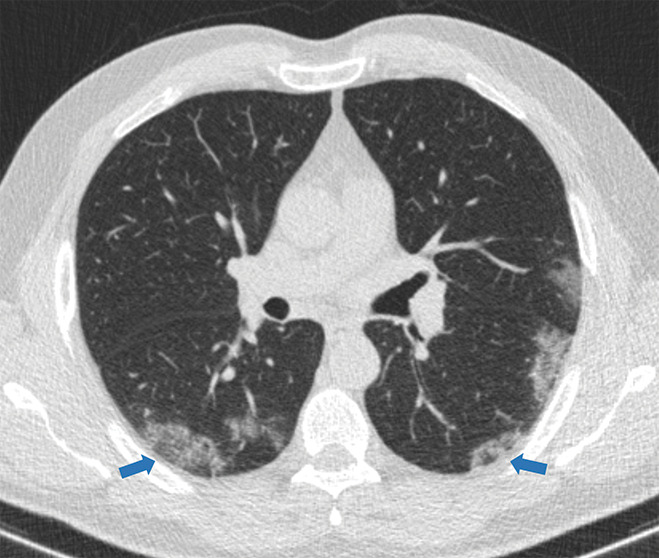 Examples of examination-level annotations on axial CT images. (a) Ground-glass opacities surrounding a nodular opacity (arrow) in the left lower lobe (halo sign). (b) Bilateral ground-glass opacities (arrows) with central clearing (reversed halo sign). (c) Reticular pattern without parenchymal opacity in the left upper lobe (arrows). (d) Perilesional vessel enlargement associated with bilateral ground-glass opacities (arrows). (e) Bronchial wall thickening most evident in the right lung (arrows). (f) Bronchiectasis in the left upper lobe (arrows). (g) Bilateral subpleural curvilinear lines (arrows). (h) Small bilateral pleural effusions (arrows). (i) Right pleural thickening (arrows). (j) Right pneumothorax (arrows). (k) Pericardial effusion (arrow). (l) Mediastinal lymphadenopathy (arrows) in the prevascular and bilateral lower paratracheal stations. (m) Pulmonary emboli (arrows) in the right lower and middle lobar pulmonary arteries.