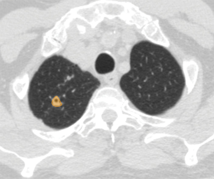 Examples of image-level annotations on axial CT images indicated with orange regions of interest. (a) Infectious opacity segmented in the left upper lobe. (b) Infectious tree-in-bud and/or micronodules segmented in the right lower lobe. (c) Infectious cavity segmented in the right upper lobe. (d) Noninfectious nodule or mass segmented in the posterior left pleura. (e) Atelectasis segmented in the left lower lobe. (f) Other noninfectious opacity segmented in the right lower lobe.