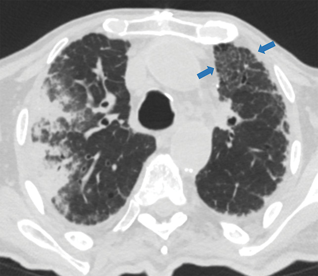 Examples of examination-level annotations on axial CT images. (a) Ground-glass opacities surrounding a nodular opacity (arrow) in the left lower lobe (halo sign). (b) Bilateral ground-glass opacities (arrows) with central clearing (reversed halo sign). (c) Reticular pattern without parenchymal opacity in the left upper lobe (arrows). (d) Perilesional vessel enlargement associated with bilateral ground-glass opacities (arrows). (e) Bronchial wall thickening most evident in the right lung (arrows). (f) Bronchiectasis in the left upper lobe (arrows). (g) Bilateral subpleural curvilinear lines (arrows). (h) Small bilateral pleural effusions (arrows). (i) Right pleural thickening (arrows). (j) Right pneumothorax (arrows). (k) Pericardial effusion (arrow). (l) Mediastinal lymphadenopathy (arrows) in the prevascular and bilateral lower paratracheal stations. (m) Pulmonary emboli (arrows) in the right lower and middle lobar pulmonary arteries.