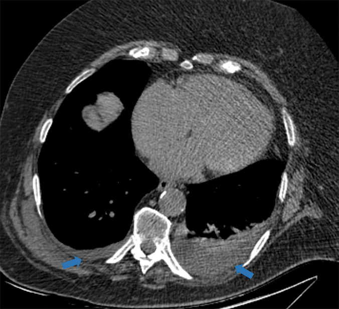 Examples of examination-level annotations on axial CT images. (a) Ground-glass opacities surrounding a nodular opacity (arrow) in the left lower lobe (halo sign). (b) Bilateral ground-glass opacities (arrows) with central clearing (reversed halo sign). (c) Reticular pattern without parenchymal opacity in the left upper lobe (arrows). (d) Perilesional vessel enlargement associated with bilateral ground-glass opacities (arrows). (e) Bronchial wall thickening most evident in the right lung (arrows). (f) Bronchiectasis in the left upper lobe (arrows). (g) Bilateral subpleural curvilinear lines (arrows). (h) Small bilateral pleural effusions (arrows). (i) Right pleural thickening (arrows). (j) Right pneumothorax (arrows). (k) Pericardial effusion (arrow). (l) Mediastinal lymphadenopathy (arrows) in the prevascular and bilateral lower paratracheal stations. (m) Pulmonary emboli (arrows) in the right lower and middle lobar pulmonary arteries.