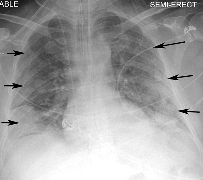 Example of CT scans and chest radiographs in the RSNA International COVID-19 Open Radiology Database. (a) Annotated axial CT image shows segmentation of characteristic bilateral multifocal ground-glass opacities in predominantly peripheral distribution (orange regions of interest). The CT image was classified as having typical appearance of coronavirus disease 2019 (COVID-19) pneumonia. (b) Annotated axial CT image shows segmentation of bilateral multifocal ground-glass opacities with diffuse distribution (orange regions of interest). The CT image was classified as having indeterminate appearance of COVID-19 pneumonia. (c) Thoracic CT image shows bilateral nodular and patchy opacities with peripheral and lower lung predominance involving four lung zones, annotated as typical for COVID-19 with moderate severity. (d) Thoracic CT image shows bilateral nodular and patchy opacities with peripheral and lower lung predominance involving more than four lung zones, annotated as typical appearance for COVID-19 and severe lung involvement. (e) Bedside chest radiograph with bilateral patchy and nodular opacities (arrows) with upper lung predominance involving more than four lung zones, annotated as indeterminate appearance for COVID-19 and severe lung involvement. (f) Bedside chest radiograph shows left lower lobe opacities (arrows) with small left pleural effusion involving a single lung zone, annotated as atypical appearance for COVID-19 and mild lung involvement. (g) Bedside chest radiograph shows bilateral patchy and nodular opacities (arrows) with upper lung predominance involving more than four lung zones, annotated as indeterminate appearance for COVID-19 and severe lung involvement. (h) Bedside chest radiograph shows left lower lobe opacity (arrow) with small left pleural effusion involving a single lung zone, annotated as atypical appearance for COVID-19 and mild lung involvement.