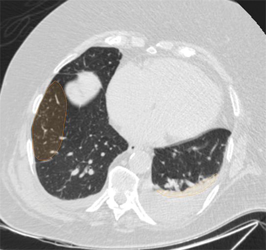 Example of CT scans and chest radiographs in the RSNA International COVID-19 Open Radiology Database. (a) Annotated axial CT image shows segmentation of characteristic bilateral multifocal ground-glass opacities in predominantly peripheral distribution (orange regions of interest). The CT image was classified as having typical appearance of coronavirus disease 2019 (COVID-19) pneumonia. (b) Annotated axial CT image shows segmentation of bilateral multifocal ground-glass opacities with diffuse distribution (orange regions of interest). The CT image was classified as having indeterminate appearance of COVID-19 pneumonia. (c) Thoracic CT image shows bilateral nodular and patchy opacities with peripheral and lower lung predominance involving four lung zones, annotated as typical for COVID-19 with moderate severity. (d) Thoracic CT image shows bilateral nodular and patchy opacities with peripheral and lower lung predominance involving more than four lung zones, annotated as typical appearance for COVID-19 and severe lung involvement. (e) Bedside chest radiograph with bilateral patchy and nodular opacities (arrows) with upper lung predominance involving more than four lung zones, annotated as indeterminate appearance for COVID-19 and severe lung involvement. (f) Bedside chest radiograph shows left lower lobe opacities (arrows) with small left pleural effusion involving a single lung zone, annotated as atypical appearance for COVID-19 and mild lung involvement. (g) Bedside chest radiograph shows bilateral patchy and nodular opacities (arrows) with upper lung predominance involving more than four lung zones, annotated as indeterminate appearance for COVID-19 and severe lung involvement. (h) Bedside chest radiograph shows left lower lobe opacity (arrow) with small left pleural effusion involving a single lung zone, annotated as atypical appearance for COVID-19 and mild lung involvement.