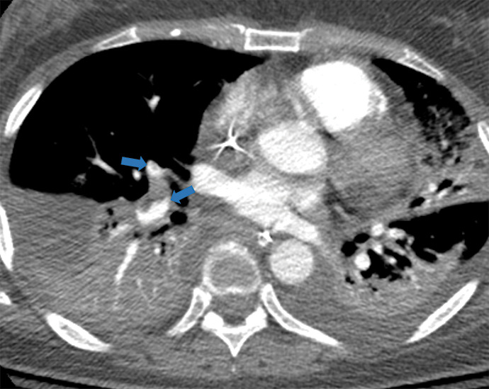 Examples of examination-level annotations on axial CT images. (a) Ground-glass opacities surrounding a nodular opacity (arrow) in the left lower lobe (halo sign). (b) Bilateral ground-glass opacities (arrows) with central clearing (reversed halo sign). (c) Reticular pattern without parenchymal opacity in the left upper lobe (arrows). (d) Perilesional vessel enlargement associated with bilateral ground-glass opacities (arrows). (e) Bronchial wall thickening most evident in the right lung (arrows). (f) Bronchiectasis in the left upper lobe (arrows). (g) Bilateral subpleural curvilinear lines (arrows). (h) Small bilateral pleural effusions (arrows). (i) Right pleural thickening (arrows). (j) Right pneumothorax (arrows). (k) Pericardial effusion (arrow). (l) Mediastinal lymphadenopathy (arrows) in the prevascular and bilateral lower paratracheal stations. (m) Pulmonary emboli (arrows) in the right lower and middle lobar pulmonary arteries.