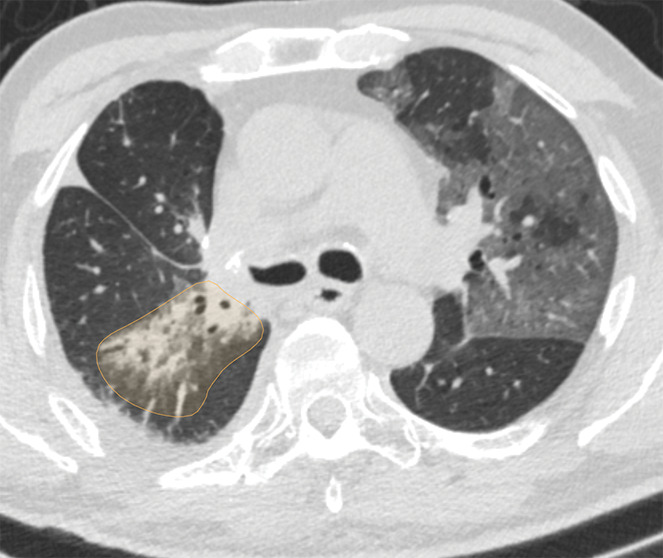 Examples of image-level annotations on axial CT images indicated with orange regions of interest. (a) Infectious opacity segmented in the left upper lobe. (b) Infectious tree-in-bud and/or micronodules segmented in the right lower lobe. (c) Infectious cavity segmented in the right upper lobe. (d) Noninfectious nodule or mass segmented in the posterior left pleura. (e) Atelectasis segmented in the left lower lobe. (f) Other noninfectious opacity segmented in the right lower lobe.