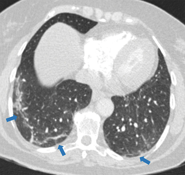 Examples of examination-level annotations on axial CT images. (a) Ground-glass opacities surrounding a nodular opacity (arrow) in the left lower lobe (halo sign). (b) Bilateral ground-glass opacities (arrows) with central clearing (reversed halo sign). (c) Reticular pattern without parenchymal opacity in the left upper lobe (arrows). (d) Perilesional vessel enlargement associated with bilateral ground-glass opacities (arrows). (e) Bronchial wall thickening most evident in the right lung (arrows). (f) Bronchiectasis in the left upper lobe (arrows). (g) Bilateral subpleural curvilinear lines (arrows). (h) Small bilateral pleural effusions (arrows). (i) Right pleural thickening (arrows). (j) Right pneumothorax (arrows). (k) Pericardial effusion (arrow). (l) Mediastinal lymphadenopathy (arrows) in the prevascular and bilateral lower paratracheal stations. (m) Pulmonary emboli (arrows) in the right lower and middle lobar pulmonary arteries.