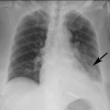 Example of CT scans and chest radiographs in the RSNA International COVID-19 Open Radiology Database. (a) Annotated axial CT image shows segmentation of characteristic bilateral multifocal ground-glass opacities in predominantly peripheral distribution (orange regions of interest). The CT image was classified as having typical appearance of coronavirus disease 2019 (COVID-19) pneumonia. (b) Annotated axial CT image shows segmentation of bilateral multifocal ground-glass opacities with diffuse distribution (orange regions of interest). The CT image was classified as having indeterminate appearance of COVID-19 pneumonia. (c) Thoracic CT image shows bilateral nodular and patchy opacities with peripheral and lower lung predominance involving four lung zones, annotated as typical for COVID-19 with moderate severity. (d) Thoracic CT image shows bilateral nodular and patchy opacities with peripheral and lower lung predominance involving more than four lung zones, annotated as typical appearance for COVID-19 and severe lung involvement. (e) Bedside chest radiograph with bilateral patchy and nodular opacities (arrows) with upper lung predominance involving more than four lung zones, annotated as indeterminate appearance for COVID-19 and severe lung involvement. (f) Bedside chest radiograph shows left lower lobe opacities (arrows) with small left pleural effusion involving a single lung zone, annotated as atypical appearance for COVID-19 and mild lung involvement. (g) Bedside chest radiograph shows bilateral patchy and nodular opacities (arrows) with upper lung predominance involving more than four lung zones, annotated as indeterminate appearance for COVID-19 and severe lung involvement. (h) Bedside chest radiograph shows left lower lobe opacity (arrow) with small left pleural effusion involving a single lung zone, annotated as atypical appearance for COVID-19 and mild lung involvement.
