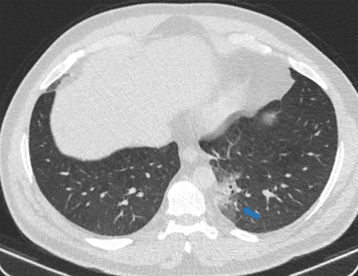 Examples of examination-level annotations on axial CT images. (a) Ground-glass opacities surrounding a nodular opacity (arrow) in the left lower lobe (halo sign). (b) Bilateral ground-glass opacities (arrows) with central clearing (reversed halo sign). (c) Reticular pattern without parenchymal opacity in the left upper lobe (arrows). (d) Perilesional vessel enlargement associated with bilateral ground-glass opacities (arrows). (e) Bronchial wall thickening most evident in the right lung (arrows). (f) Bronchiectasis in the left upper lobe (arrows). (g) Bilateral subpleural curvilinear lines (arrows). (h) Small bilateral pleural effusions (arrows). (i) Right pleural thickening (arrows). (j) Right pneumothorax (arrows). (k) Pericardial effusion (arrow). (l) Mediastinal lymphadenopathy (arrows) in the prevascular and bilateral lower paratracheal stations. (m) Pulmonary emboli (arrows) in the right lower and middle lobar pulmonary arteries.