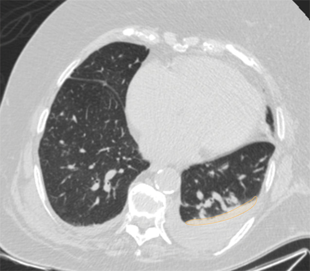 Examples of image-level annotations on axial CT images indicated with orange regions of interest. (a) Infectious opacity segmented in the left upper lobe. (b) Infectious tree-in-bud and/or micronodules segmented in the right lower lobe. (c) Infectious cavity segmented in the right upper lobe. (d) Noninfectious nodule or mass segmented in the posterior left pleura. (e) Atelectasis segmented in the left lower lobe. (f) Other noninfectious opacity segmented in the right lower lobe.