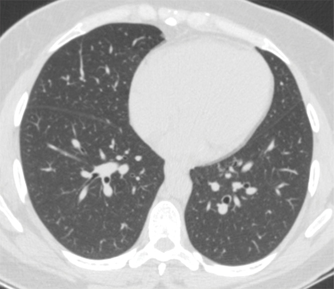 Example of CT scans and chest radiographs in the RSNA International COVID-19 Open Radiology Database. (a) Annotated axial CT image shows segmentation of characteristic bilateral multifocal ground-glass opacities in predominantly peripheral distribution (orange regions of interest). The CT image was classified as having typical appearance of coronavirus disease 2019 (COVID-19) pneumonia. (b) Annotated axial CT image shows segmentation of bilateral multifocal ground-glass opacities with diffuse distribution (orange regions of interest). The CT image was classified as having indeterminate appearance of COVID-19 pneumonia. (c) Thoracic CT image shows bilateral nodular and patchy opacities with peripheral and lower lung predominance involving four lung zones, annotated as typical for COVID-19 with moderate severity. (d) Thoracic CT image shows bilateral nodular and patchy opacities with peripheral and lower lung predominance involving more than four lung zones, annotated as typical appearance for COVID-19 and severe lung involvement. (e) Bedside chest radiograph with bilateral patchy and nodular opacities (arrows) with upper lung predominance involving more than four lung zones, annotated as indeterminate appearance for COVID-19 and severe lung involvement. (f) Bedside chest radiograph shows left lower lobe opacities (arrows) with small left pleural effusion involving a single lung zone, annotated as atypical appearance for COVID-19 and mild lung involvement. (g) Bedside chest radiograph shows bilateral patchy and nodular opacities (arrows) with upper lung predominance involving more than four lung zones, annotated as indeterminate appearance for COVID-19 and severe lung involvement. (h) Bedside chest radiograph shows left lower lobe opacity (arrow) with small left pleural effusion involving a single lung zone, annotated as atypical appearance for COVID-19 and mild lung involvement.