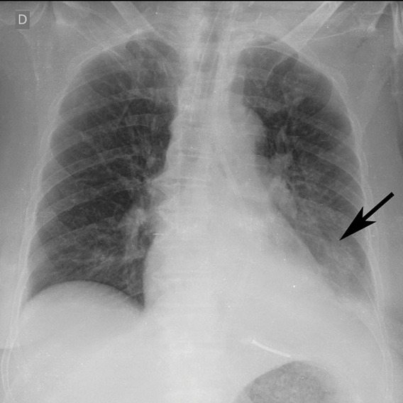 Example of CT scans and chest radiographs in the RSNA International COVID-19 Open Radiology Database. (a) Annotated axial CT image shows segmentation of characteristic bilateral multifocal ground-glass opacities in predominantly peripheral distribution (orange regions of interest). The CT image was classified as having typical appearance of coronavirus disease 2019 (COVID-19) pneumonia. (b) Annotated axial CT image shows segmentation of bilateral multifocal ground-glass opacities with diffuse distribution (orange regions of interest). The CT image was classified as having indeterminate appearance of COVID-19 pneumonia. (c) Thoracic CT image shows bilateral nodular and patchy opacities with peripheral and lower lung predominance involving four lung zones, annotated as typical for COVID-19 with moderate severity. (d) Thoracic CT image shows bilateral nodular and patchy opacities with peripheral and lower lung predominance involving more than four lung zones, annotated as typical appearance for COVID-19 and severe lung involvement. (e) Bedside chest radiograph with bilateral patchy and nodular opacities (arrows) with upper lung predominance involving more than four lung zones, annotated as indeterminate appearance for COVID-19 and severe lung involvement. (f) Bedside chest radiograph shows left lower lobe opacities (arrows) with small left pleural effusion involving a single lung zone, annotated as atypical appearance for COVID-19 and mild lung involvement. (g) Bedside chest radiograph shows bilateral patchy and nodular opacities (arrows) with upper lung predominance involving more than four lung zones, annotated as indeterminate appearance for COVID-19 and severe lung involvement. (h) Bedside chest radiograph shows left lower lobe opacity (arrow) with small left pleural effusion involving a single lung zone, annotated as atypical appearance for COVID-19 and mild lung involvement.