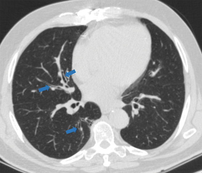 Examples of examination-level annotations on axial CT images. (a) Ground-glass opacities surrounding a nodular opacity (arrow) in the left lower lobe (halo sign). (b) Bilateral ground-glass opacities (arrows) with central clearing (reversed halo sign). (c) Reticular pattern without parenchymal opacity in the left upper lobe (arrows). (d) Perilesional vessel enlargement associated with bilateral ground-glass opacities (arrows). (e) Bronchial wall thickening most evident in the right lung (arrows). (f) Bronchiectasis in the left upper lobe (arrows). (g) Bilateral subpleural curvilinear lines (arrows). (h) Small bilateral pleural effusions (arrows). (i) Right pleural thickening (arrows). (j) Right pneumothorax (arrows). (k) Pericardial effusion (arrow). (l) Mediastinal lymphadenopathy (arrows) in the prevascular and bilateral lower paratracheal stations. (m) Pulmonary emboli (arrows) in the right lower and middle lobar pulmonary arteries.