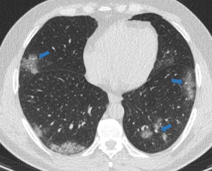 Examples of examination-level annotations on axial CT images. (a) Ground-glass opacities surrounding a nodular opacity (arrow) in the left lower lobe (halo sign). (b) Bilateral ground-glass opacities (arrows) with central clearing (reversed halo sign). (c) Reticular pattern without parenchymal opacity in the left upper lobe (arrows). (d) Perilesional vessel enlargement associated with bilateral ground-glass opacities (arrows). (e) Bronchial wall thickening most evident in the right lung (arrows). (f) Bronchiectasis in the left upper lobe (arrows). (g) Bilateral subpleural curvilinear lines (arrows). (h) Small bilateral pleural effusions (arrows). (i) Right pleural thickening (arrows). (j) Right pneumothorax (arrows). (k) Pericardial effusion (arrow). (l) Mediastinal lymphadenopathy (arrows) in the prevascular and bilateral lower paratracheal stations. (m) Pulmonary emboli (arrows) in the right lower and middle lobar pulmonary arteries.