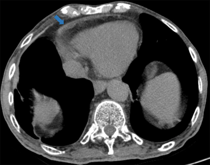 Examples of examination-level annotations on axial CT images. (a) Ground-glass opacities surrounding a nodular opacity (arrow) in the left lower lobe (halo sign). (b) Bilateral ground-glass opacities (arrows) with central clearing (reversed halo sign). (c) Reticular pattern without parenchymal opacity in the left upper lobe (arrows). (d) Perilesional vessel enlargement associated with bilateral ground-glass opacities (arrows). (e) Bronchial wall thickening most evident in the right lung (arrows). (f) Bronchiectasis in the left upper lobe (arrows). (g) Bilateral subpleural curvilinear lines (arrows). (h) Small bilateral pleural effusions (arrows). (i) Right pleural thickening (arrows). (j) Right pneumothorax (arrows). (k) Pericardial effusion (arrow). (l) Mediastinal lymphadenopathy (arrows) in the prevascular and bilateral lower paratracheal stations. (m) Pulmonary emboli (arrows) in the right lower and middle lobar pulmonary arteries.