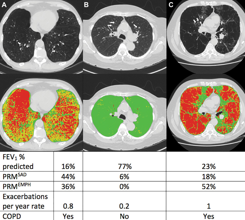 Axial noncontrast CT scans (top row) and corresponding images from parametric response mapping (PRM) (bottom row) for small airway disease (SAD) and emphysema illustrate bronchiectasis. CT scans show bronchiectasis (arrows), and color-coded images show emphysema in red, SAD in yellow, and normal areas in green. Values of PRM measures, predicted percentage for forced expiratory volume in 1 second (FEV1), and the rates of exacerbation per year are shown in the table. A, Images in a participant with CT-derived bronchiectasis and severe chronic obstructive pulmonary disease (COPD). B, Images in a participant with CT-derived bronchiectasis without COPD. C, Images in a participant with CT-derived bronchiectasis and severe COPD. PRMEMPH = emphysema at PRM, PRMSAD = small airway disease at PRM.