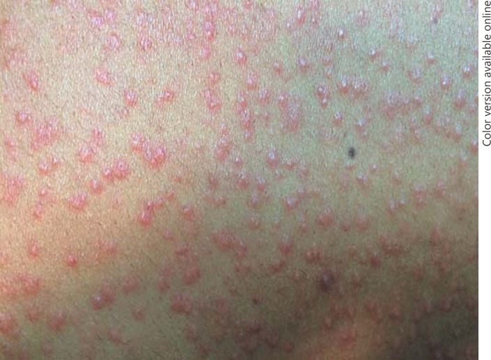 Acneiform Rash Caused by an Unlikely Drug: Topiramate - PMC