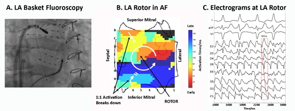 Comparing Antiarrhythmic Drugs And Catheter Ablation For Treatment Of 