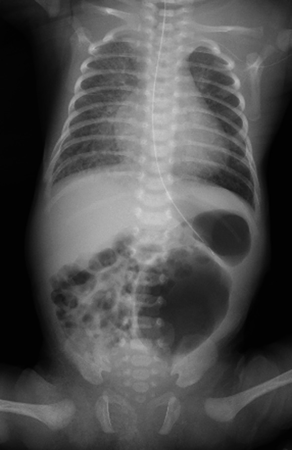 A Case Of Hirschsprung’s Disease With Segmental Dilatation Of The Colon 