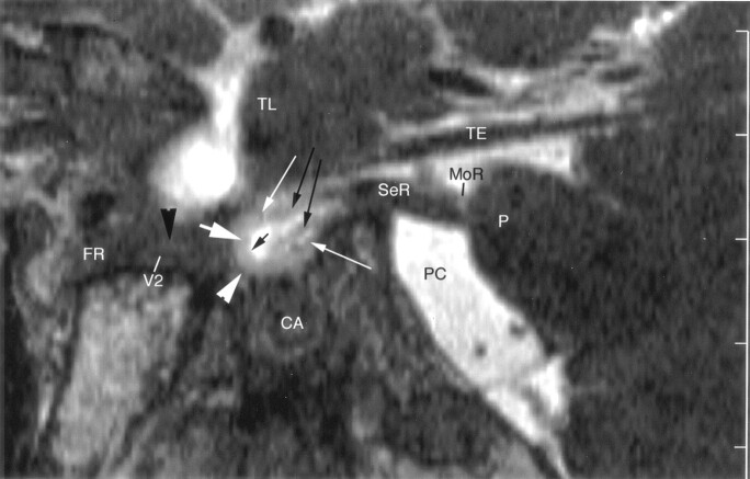 Trigeminal Ganglion and its Divisions: Detailed Anatomic MR Imaging ...