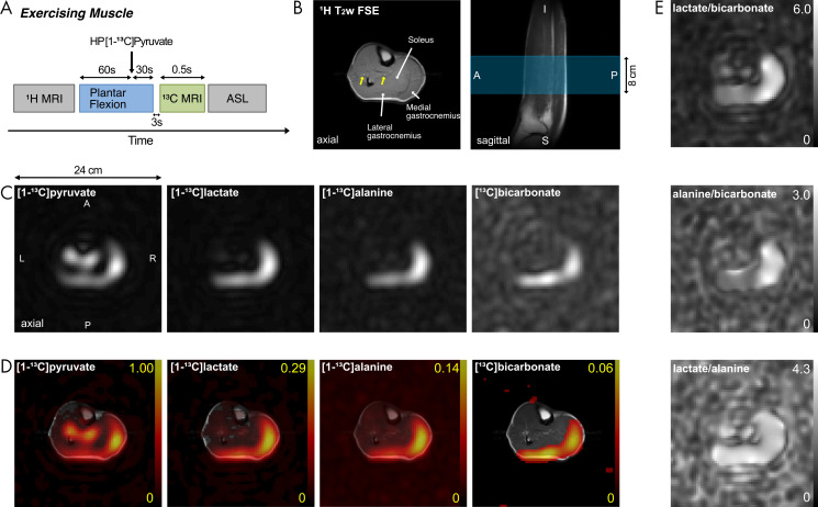 Metabolic imaging of calf muscle with exercise. A, Diagram shows how hyperpolarized (HP) carbon 13 (13C) MRI was performed in exercising muscle. ASL = arterial spin labeling, 1H = hydrogen 1. B, 1H T2-weighted (T2w) fast spin-echo (FSE) MRI scan of 8-cm axial section in study participant 6 (34-year-old man). Blue region in sagittal MRI scan indicates prescribed axial section for 13C MRI. Yellow arrows indicate arteries. A = anterior, I = inferior, P = posterior, S = superior. C, Time-averaged metabolite maps of hyperpolarized [1-13C]-pyruvate, [1-13C]-lactate, [1-13C]-alanine, and [13C]-bicarbonate. A = anterior, L = left, P = posterior, R = right. D, 13C metabolite maps, normalized with peak [1-13C]-pyruvate signal and overlaid on corresponding hydrogen 1 fast spin-echo image of section. E, Metabolite ratio maps of carbon 13 products—lactate-to-bicarbonate ratio, alanine-to-bicarbonate ratio, and lactate-to-alanine ratio.