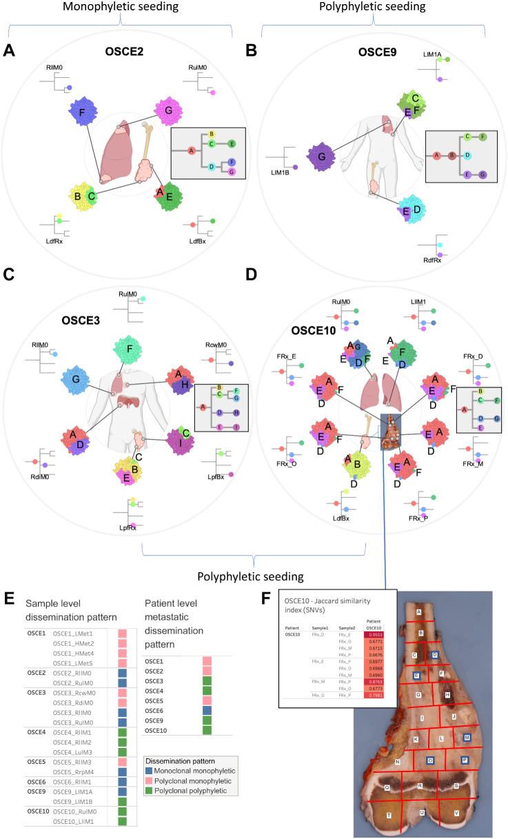 Figure 5. SNV-based phylogenies highlighting spatial evolution and descriptions of metastatic seeding patterns at the sample and patient level. A–D, Spatially and in some cases temporally distinct samples are indicated on the anatomic sites from where the sample originated. The colors represent different clones, and the phylogenetic trees show the evolutionary relationships between these clones. The prevalence of each clone at a particular site is proportional to the colored area of the cellular aggregate representation. E, Sample and patient level dissemination patterns are characterized in these charts. Monoclonal dissemination: single subclone within the primary tumor seeds one or more metastatic lesions; polyclonal dissemination: multiple distinct subclones from the primary tumor seed one or more metastatic lesions; monophyletic origin: all metastatic clones are derived from a recent common ancestor; polyphyletic origin: metastasizing clones are more similar to other subclones within the primary tumor than they are to each other. These descriptions can be considered at the sample level, focused on the clonal make up of a single metastatic site compared with the primary tumor, or taken as a whole, evaluating all spatially or temporally separated samples and how they relate back to the primary tumor. F, Multiregion sequencing was performed on a primary resection sample from OSCE10. Regions D, E, M, O, P were sequenced from the specimen grid depicted. A table of Jaccard similarity indexes based on shared SNVs for these samples is shown in the top left inset. (A–D, Created with BioRender.com.)