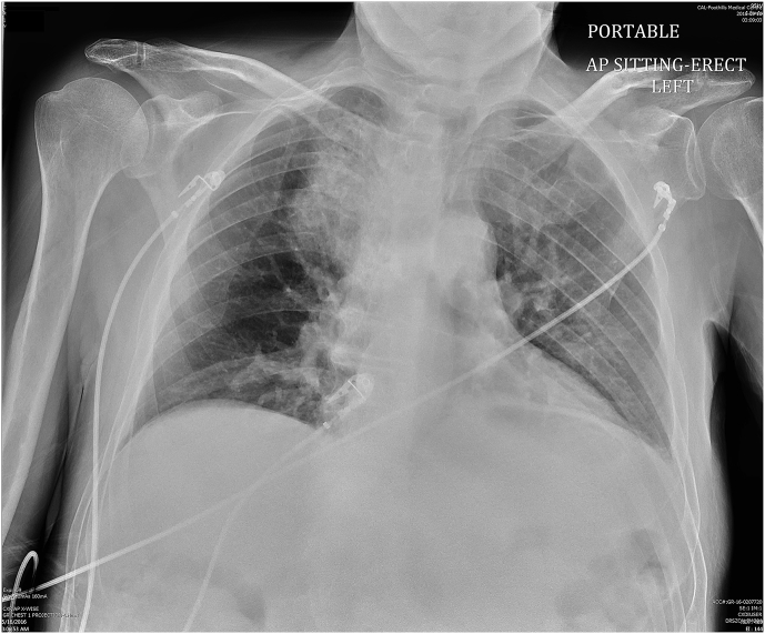 An unusual case of massive hemoptysis due to Bacillus cereus ...