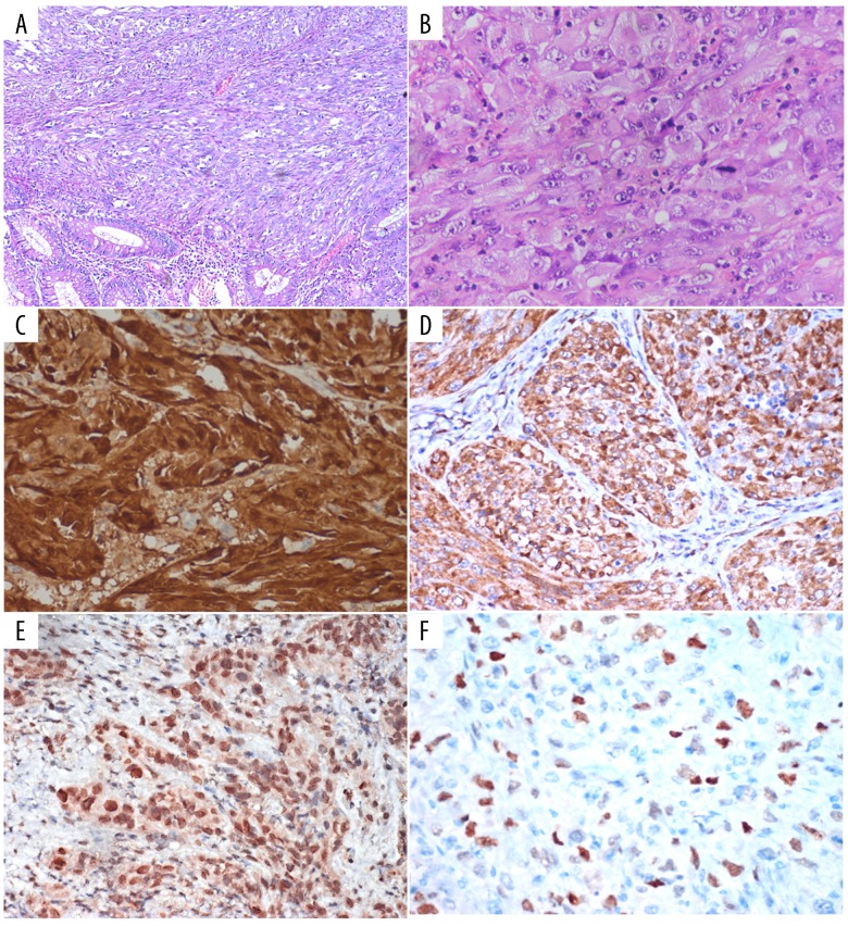 Epithelioid Malignant Peripheral Nerve Sheath Tumor (Epithelioid-MPNST ...