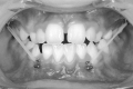 Figure 1. Elastic traction is applied from the upper bone plates to the lower bone plates for 24 hours a day over a period of 1 year.