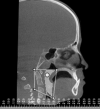 Figure 3. Borders of airway volume are shown. The superior border includes the most posterior point of the bony posterior nasal spine to basion, while the inferior border is defined by a line from the inferior edge of C3 to the base of the epiglottis.