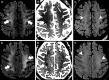 Axial brain MRI scans in two critically ill patients with coronavirus disease 2019 with persistently diminished mental status. A–C, Images in a 56-year-old man. D–F, Images in a 64-year-old man. A, D, Diffusion-weighted images, B, E, apparent diffusion coefficient maps, and, C, F, fluid-attenuated inversion recovery images at the level of centrum semiovale demonstrate symmetric diffuse T2 hyperintensity (arrowheads) and mild restricted diffusion (thick arrows) involving the deep and subcortical white matter with relative sparing of juxtacortical white matter (thin arrows) in both patients. The restricted diffusion is more conspicuous than the T2 hyperintensity.