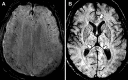 Axial susceptibility-weighted images in two critically ill patients with coronavirus disease 2019. A, Image obtained in a 45-year-old man after 23 days of mechanical ventilation. B, Image obtained in a 56-year-old man after 17 days of mechanical ventilation. Images demonstrate numerous punctate microhemorrhagic foci within the juxtacortical white matter, particularly near the depth of the sulci (A), and multiple punctate microhemorrhages within the corpus callosum, particularly in the splenium (arrows in B).