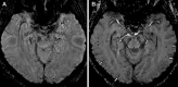 Axial susceptibility-weighted images in a 64-year-old man. A, Image obtained 1 week before the current hospital encounter, during work-up for headaches. B, Image obtained after 23 days of mechanical ventilation in the hospital intensive care unit due to coronavirus disease 2019 show multiple juxtacortical punctate microhemorrhages in bilateral temporal and right occipital lobes (arrows) that were not on the previous MRI scan.