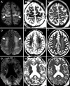 Axial brain MRI scans in a 63-year-old woman who was critically ill due to coronavirus disease 2019. The patient had persistently diminished mental status after 27 days of mechanical ventilation. A, D, G, Diffusion-weighted images, B, E, H, apparent diffusion coefficient maps, and, C, F, I, T2-weighted images at the levels of, A–C, paracentral lobule, D–F, centrum semiovale, and, G–I, corona radiata demonstrate confluent symmetric T2 hyperintensity and restricted diffusion extending from the juxtacortical and subcortical white matter of the precentral gyrus (arrows in A–C) down to the centrum semiovale (arrows in D–F) and down through the posterior limbs of the internal capsules (arrows in G–I) and occipital lobe juxtacortical and subcortical white matter (arrowheads in G–I).