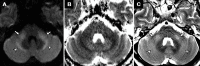 Axial brain MRI scans in a 64-year-old man who was critically ill due to coronavirus disease 2019. Images were obtained after 28 days of mechanical ventilation. A, Diffusion-weighted image, B, apparent diffusion coefficient map, and, C, T2-weighted image demonstrate patchy faint areas of restricted diffusion and T2 hyperintensity in the middle cerebellar peduncles (arrows) and in the white matter lateral to the deep cerebellar nuclei (arrowheads). The remaining parts of the brainstem and cerebellum are normal.