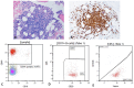 The bone marrow biopsy showed a dense accumulation of small lymphocytes, which were positive for CD19 and CD20 by immunostaining. The monoclonal B-cell population exhibited kappa light restriction and was negative for CD5 and CD10, indicative of a potential B-cell lymphoma diagnosis.