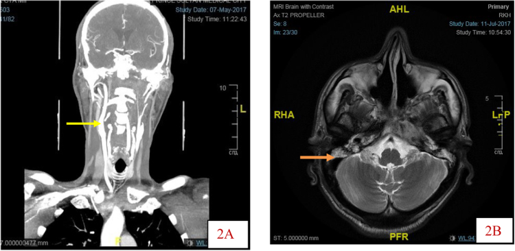 Treatment Of Cerebral Mucormycosis With Drug Therapy Alone: A Case 