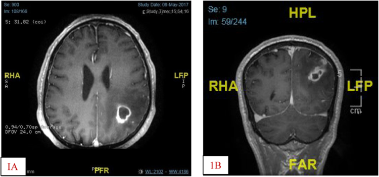 Treatment Of Cerebral Mucormycosis With Drug Therapy Alone: A Case 