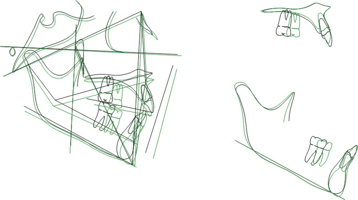 Figure 3. Cephalometric tracing superimposition of a case treated with continuous arch mechanics.